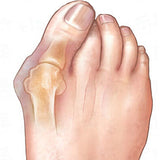 realign big toe bone correction corrector discomfort pain protect protection repair fix corns bunion calluses